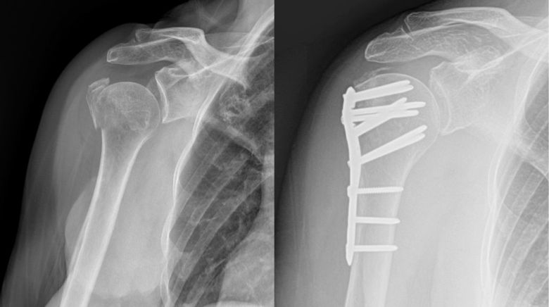 proximal humerus fig2 20